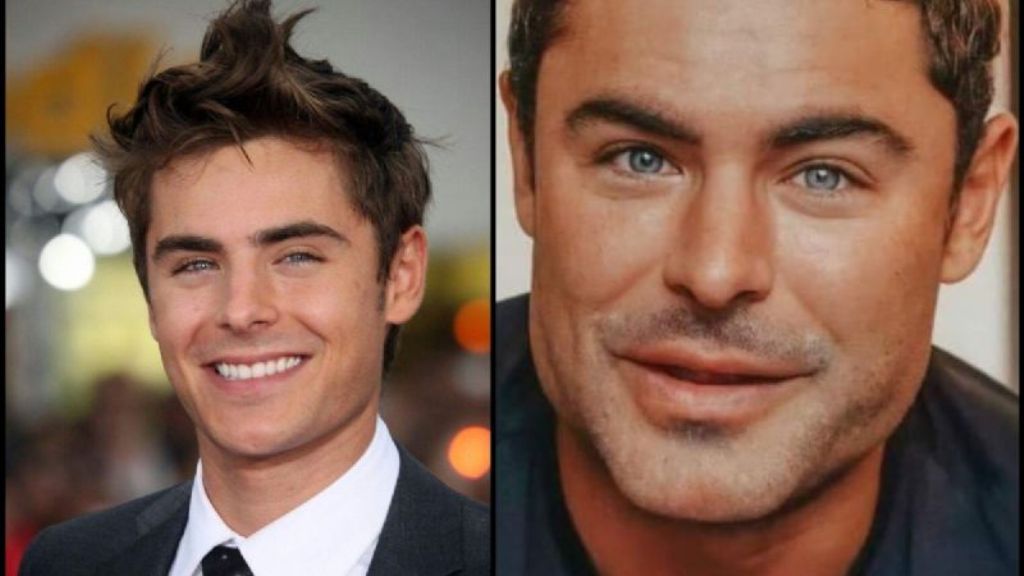 ¡Abusaron del bótox! Zac Efron y otros famosos que “destrozaron” su rostro